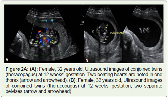 Cephalothoracopagus A Rare Congenital Anomaly